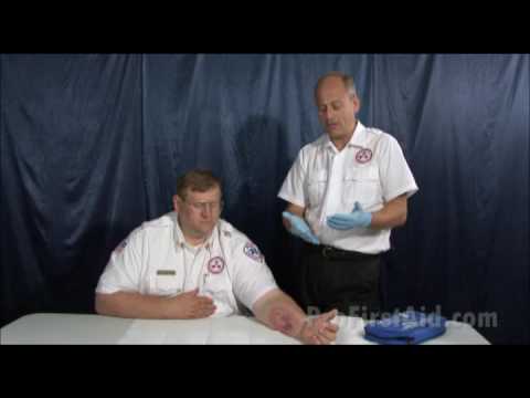 How to Treat a Burn - First Aid in 5 Steps