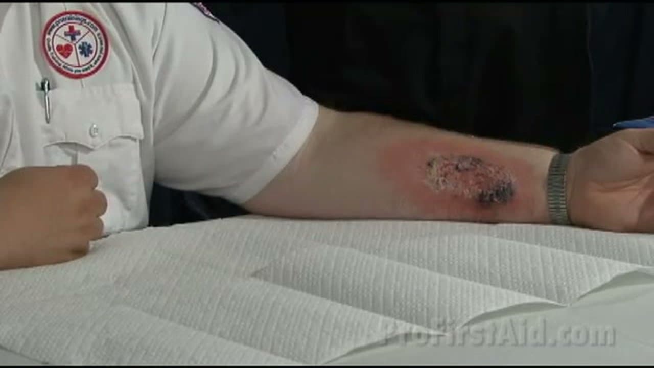 How to Treat a Burn - First Aid in 5 Steps